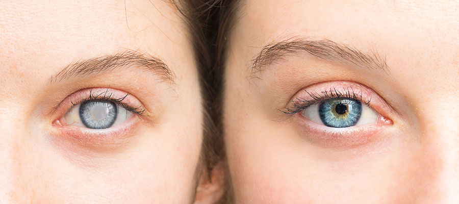 eye-condition-title-lichtenburg
